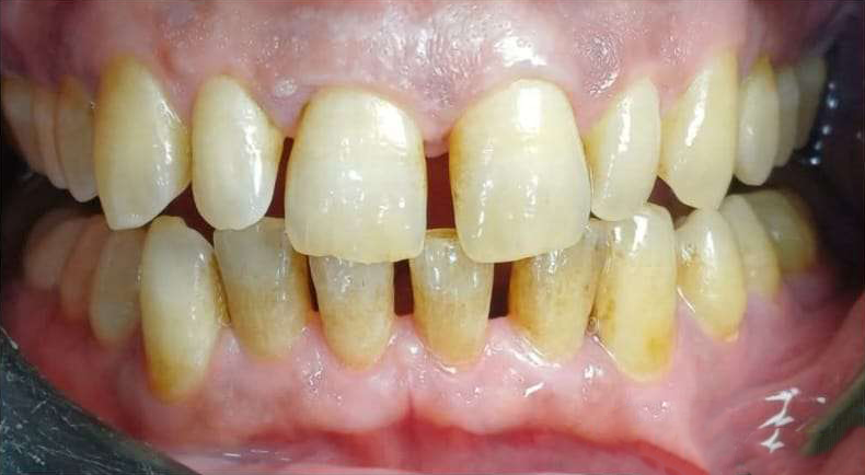 قبل — حشوات تجميلية أمامية